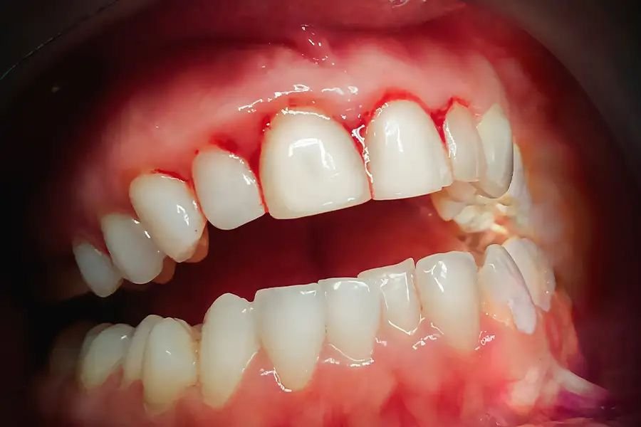 Gingivitis / Gum Disease Treatment.