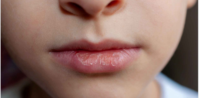 Dry Mouth Treatment in Gurugram